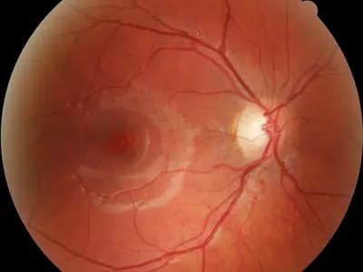 A fundus photograph of the retina at the back of the eye