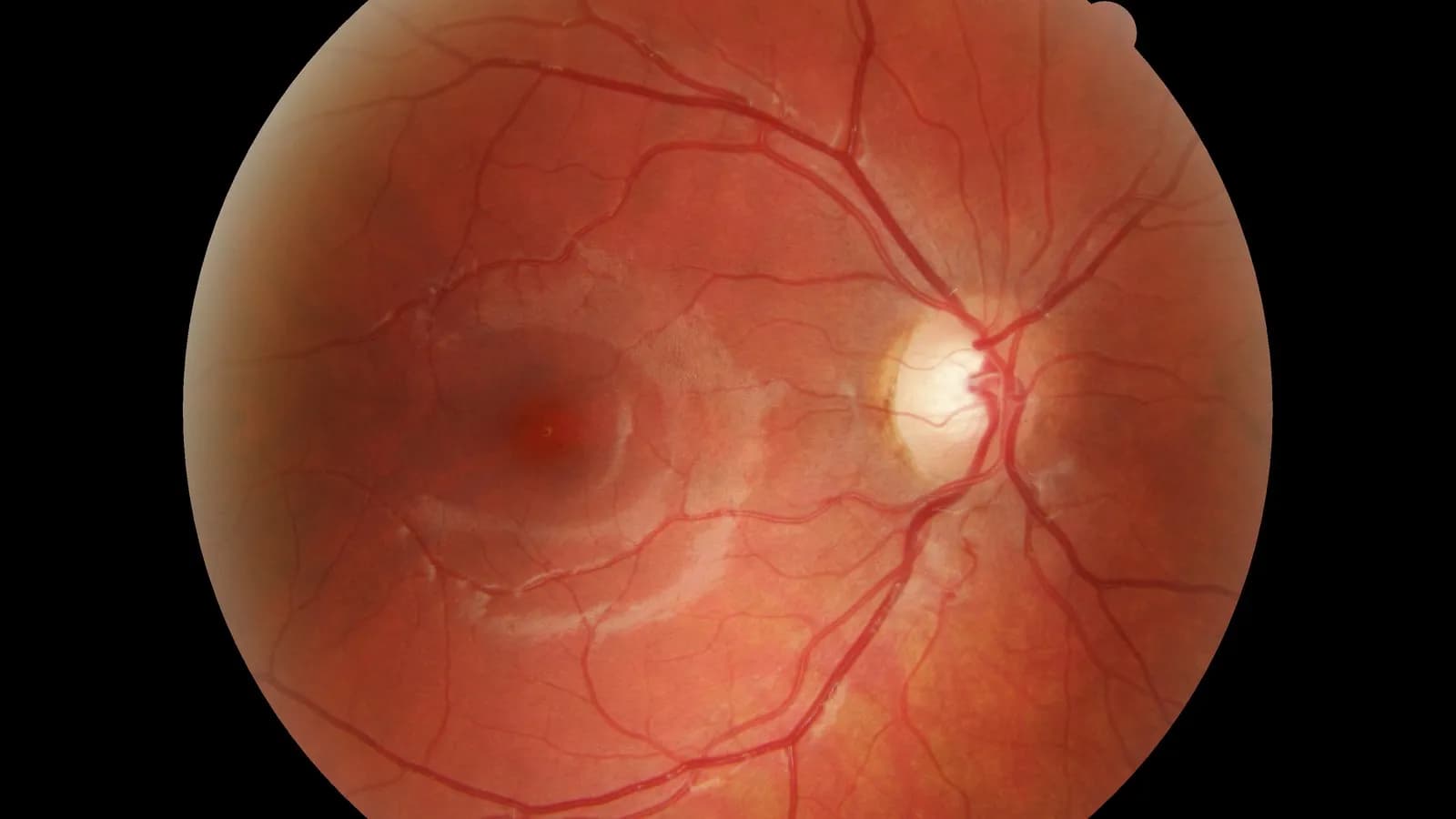 A fundus photograph of the retina at the back of the eye
