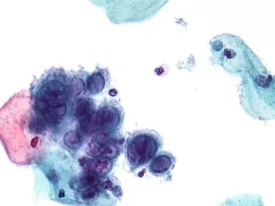 A cluster of herpes-infected cells with enlarged, moulded nuclei seen under a microscope in a stained cervical smear, a file micrograph illustrative of herpes simplex virus infection and not of any patient in the trial