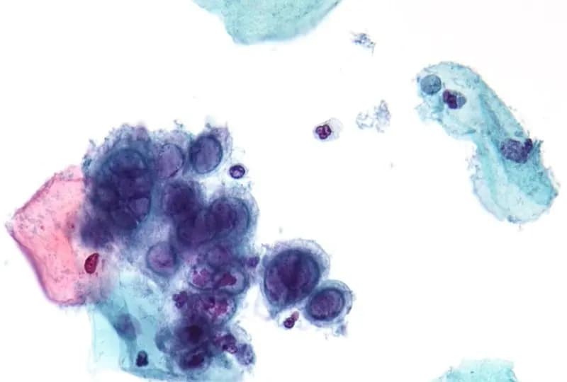 A cluster of herpes-infected cells with enlarged, moulded nuclei seen under a microscope in a stained cervical smear, a file micrograph illustrative of herpes simplex virus infection and not of any patient in the trial
