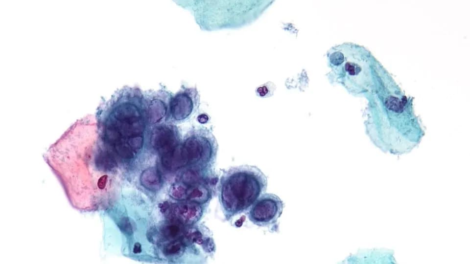 A cluster of herpes-infected cells with enlarged, moulded nuclei seen under a microscope in a stained cervical smear, a file micrograph illustrative of herpes simplex virus infection and not of any patient in the trial