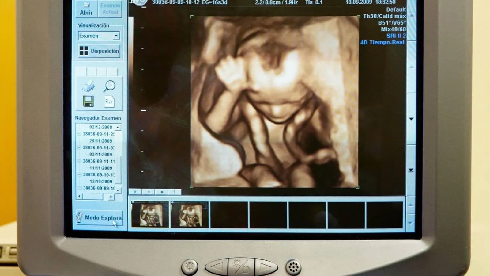 An ultrasound scanner display during a scan