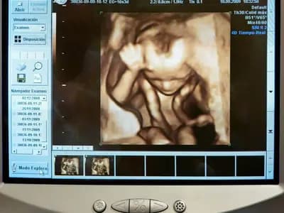An ultrasound scanner display during a scan