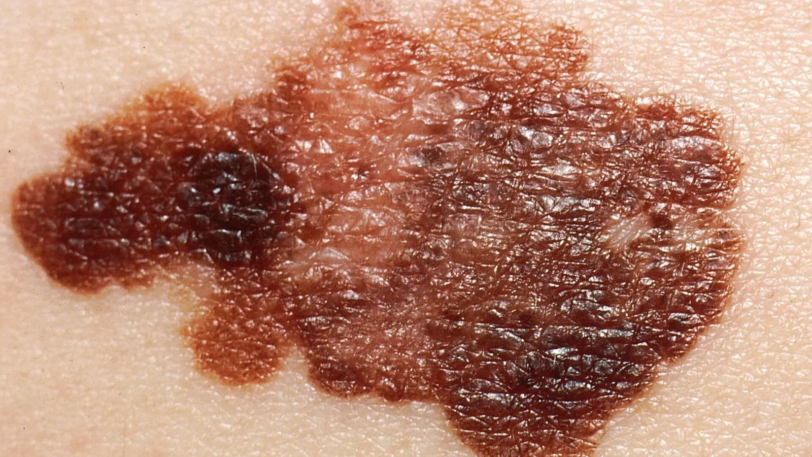A close-up of an irregular, dark brown melanoma on pale skin, from a 1985 slide, a file medical photograph illustrative of the disease and not of any trial participant