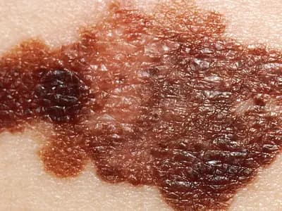 A close-up of an irregular, dark brown melanoma on pale skin, from a 1985 slide, a file medical photograph illustrative of the disease and not of any trial participant