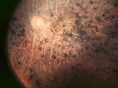 A fundus photograph of the retina of a patient with end-stage retinitis pigmentosa, showing pigment deposits across the retina, published in 2006, a clinical illustration of the disease and not an image from the trial