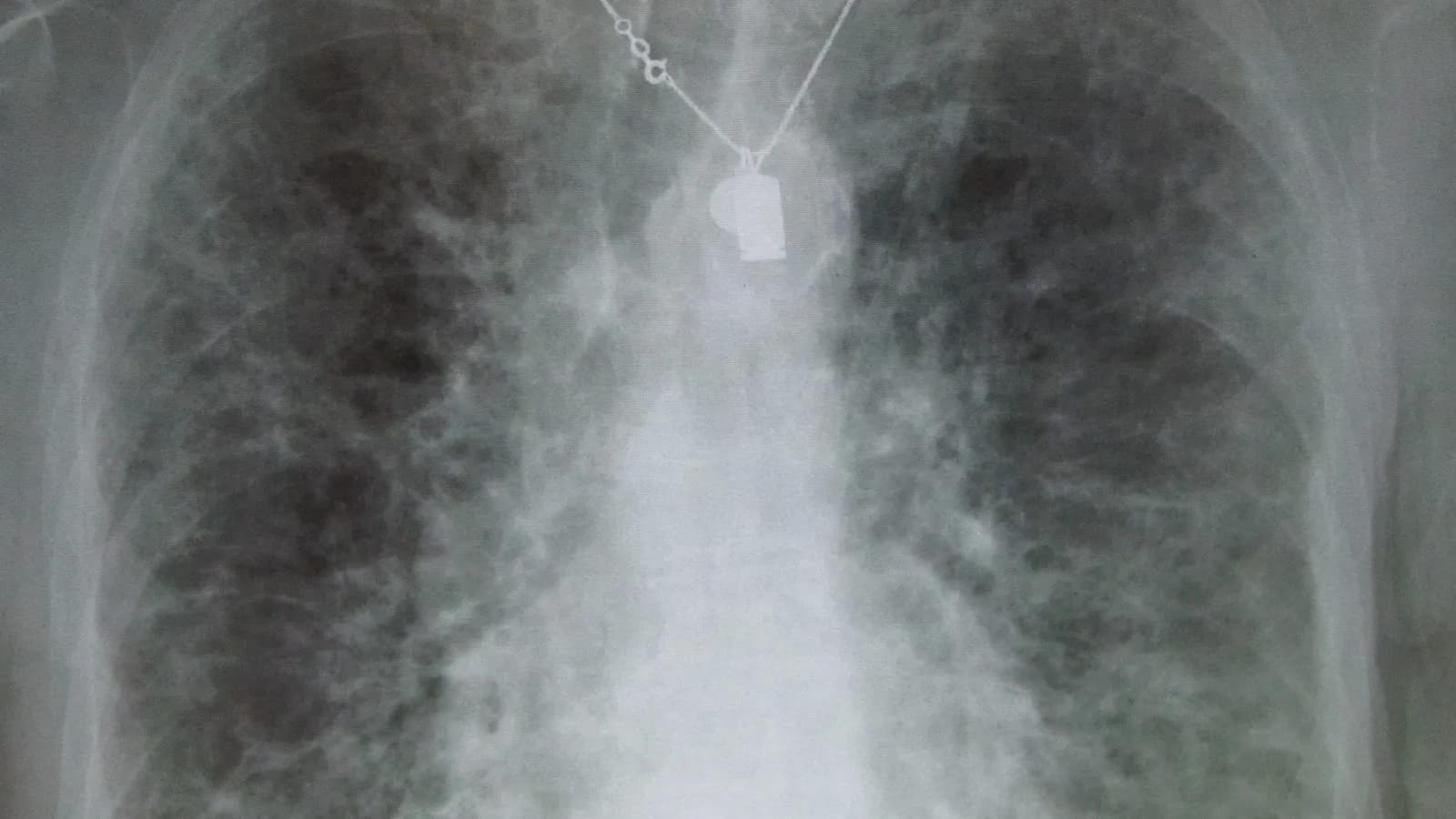 A chest X-ray showing the scarring pattern of pulmonary fibrosis, the disease rentosertib was designed to treat