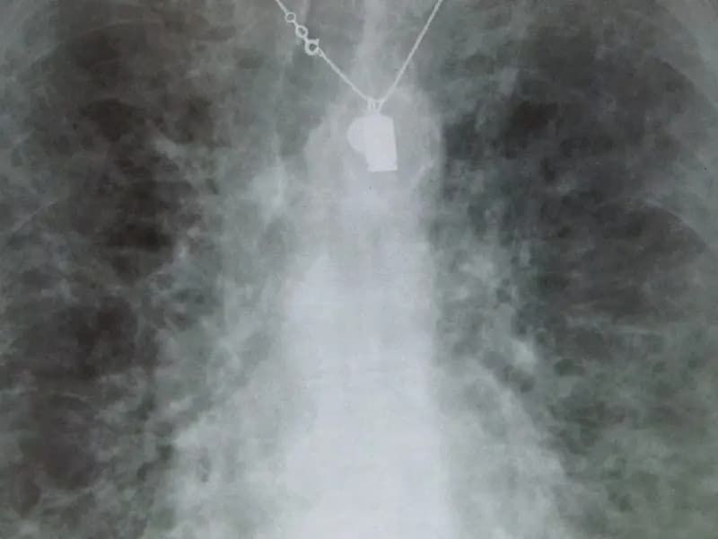 A chest X-ray showing the scarring pattern of pulmonary fibrosis, the disease rentosertib was designed to treat